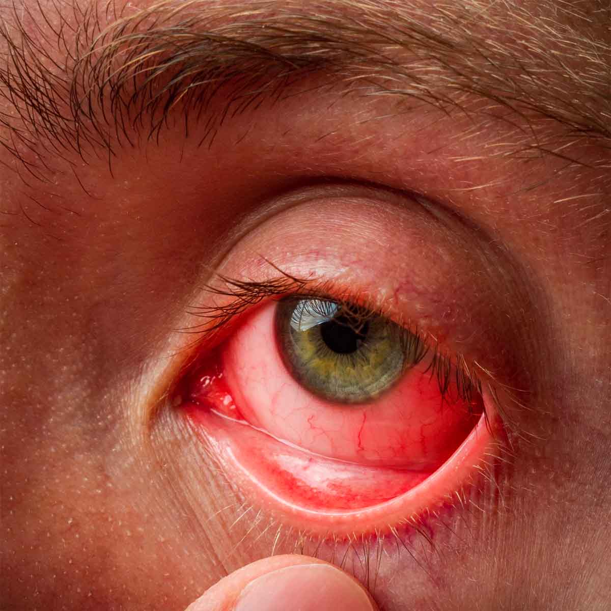 https://testing.prentjiespreke.com/wp-content/uploads/2022/10/Conjunctivitis.jpg